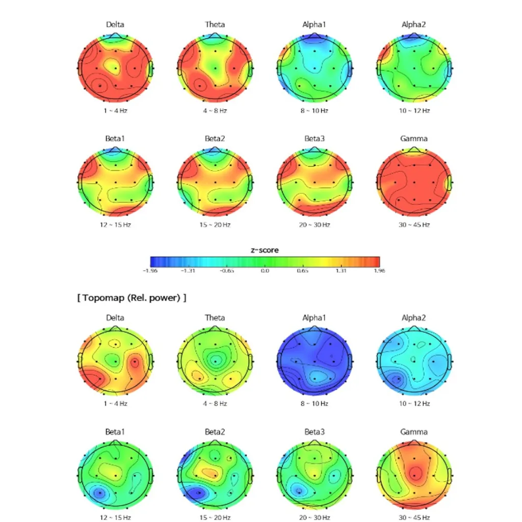 Mapeo cerebral cuantitativo qEEG para la ansiedad